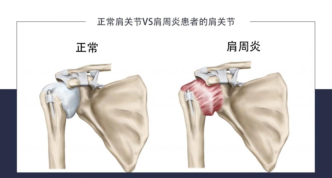 📌其实肩周炎和肩袖损伤很容易区分