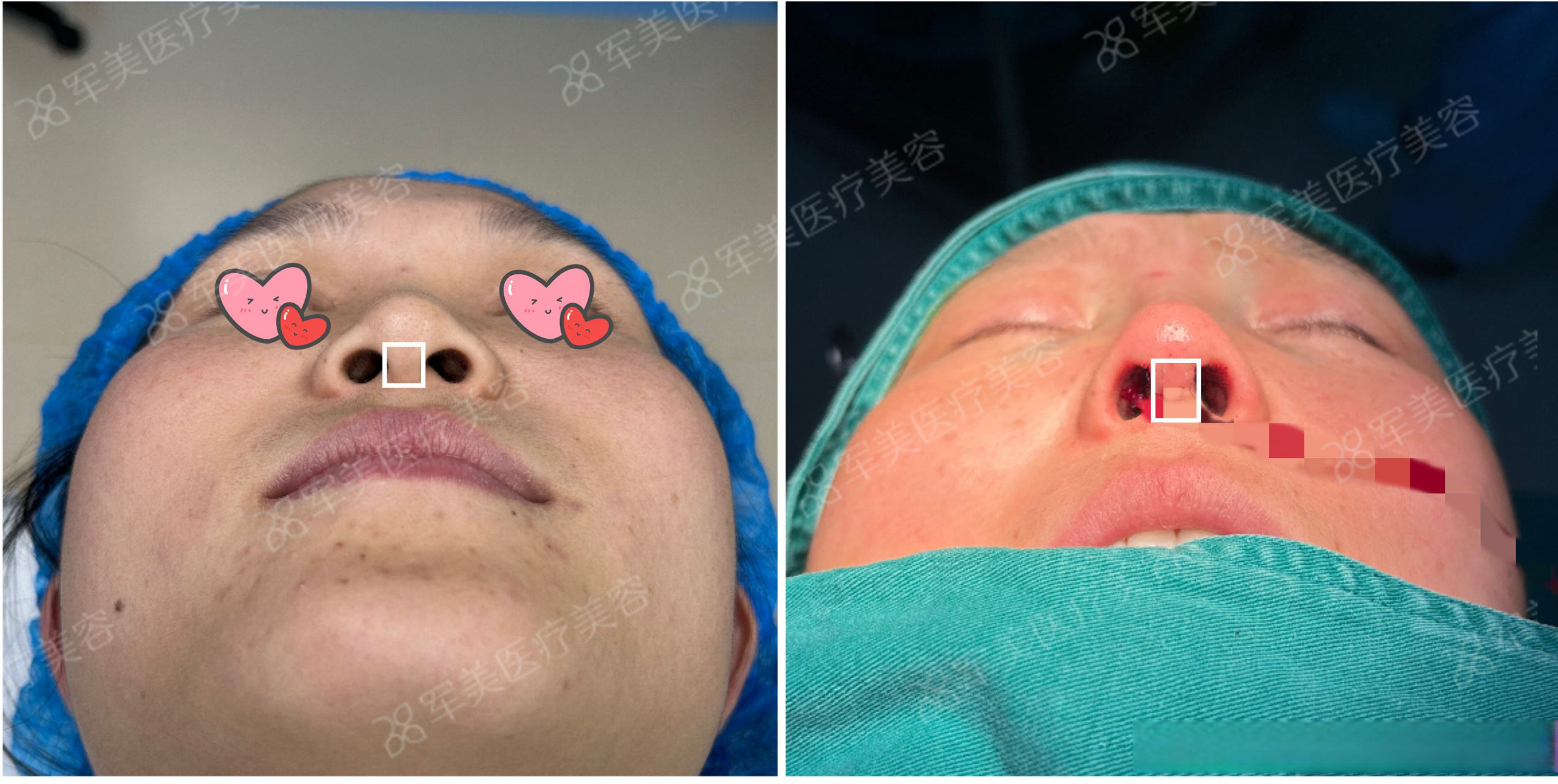 鼻小柱延长术针对不同的情况在鼻孔,鼻小柱周围进行矫正,如果鼻小柱