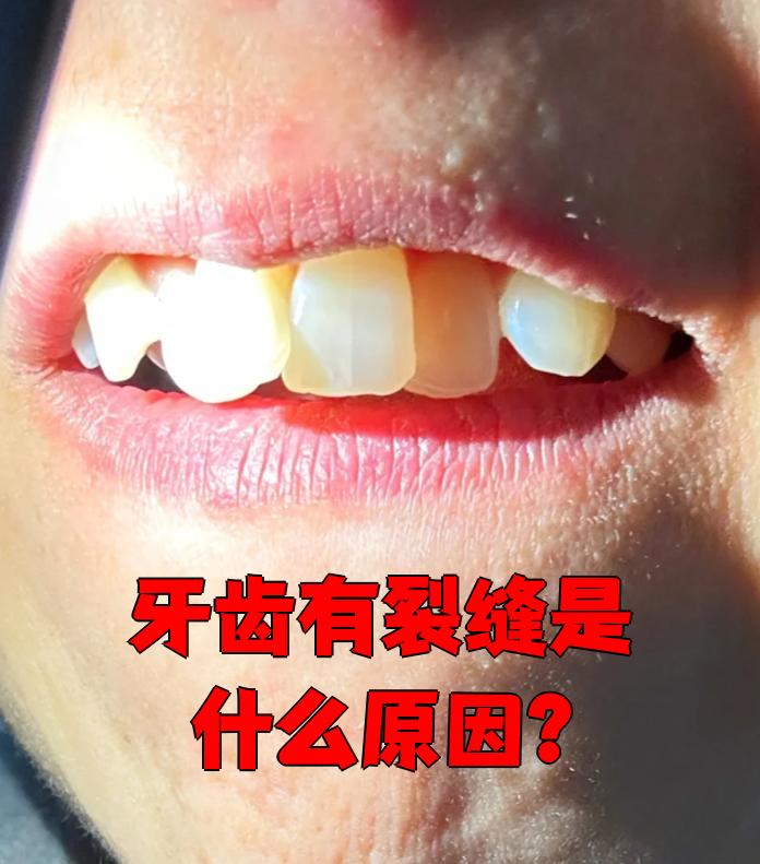 牙齿有裂痕出现是因为什么原因 百度百科为什么在线