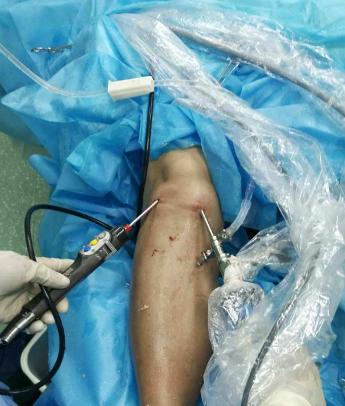 膝关节半月板撕裂后能否恢复,主要看撕裂程度和是否适合缝合