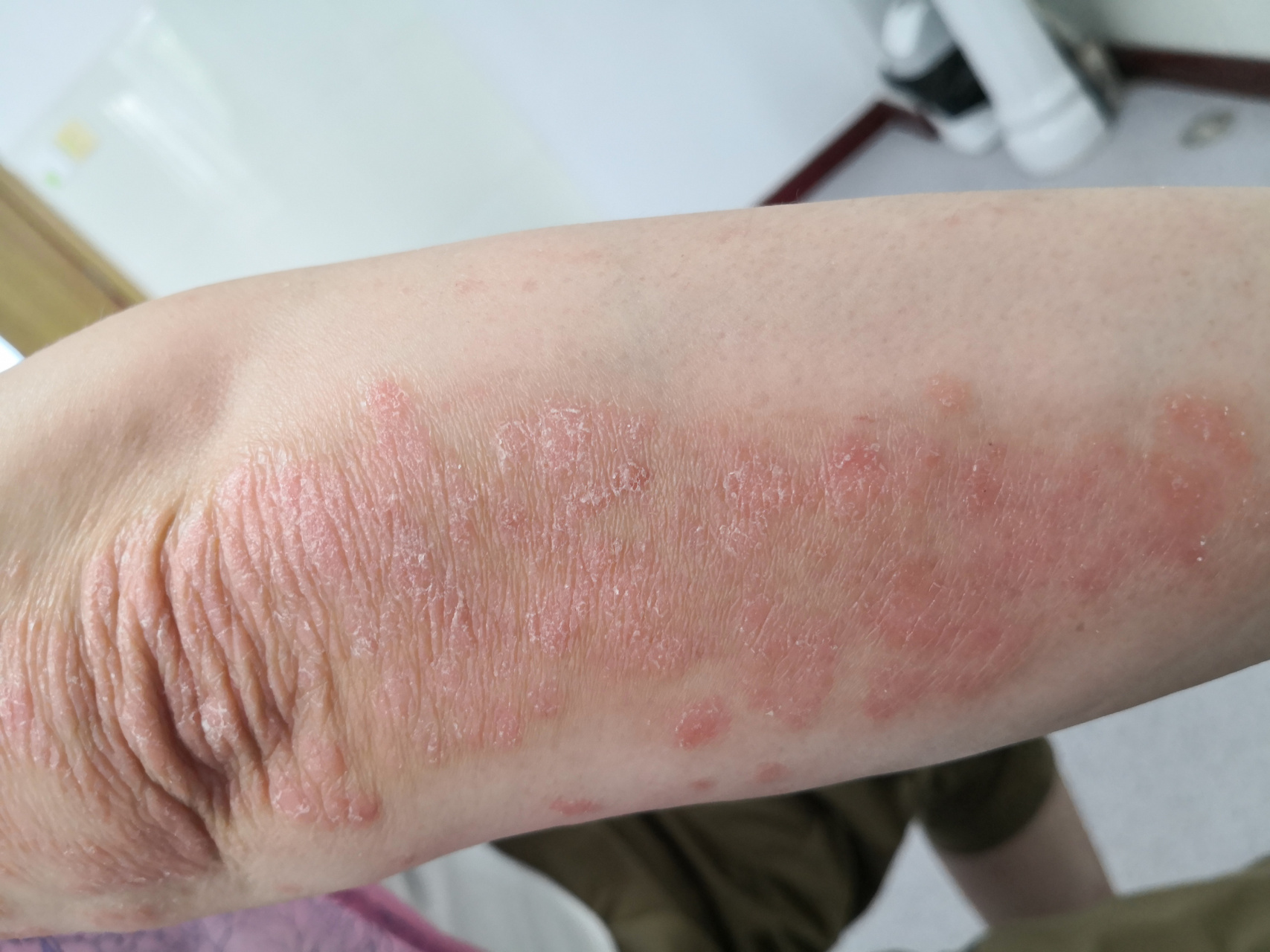 解决皮肤问题专注皮肤美容##银屑病