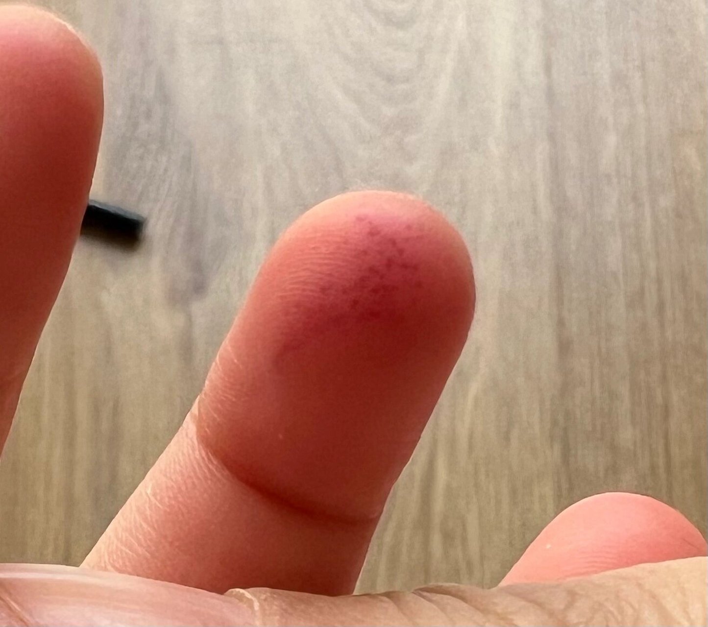 手指出血点是怎么了? 孩子幼儿园回来,说是手碰了花所以这样?