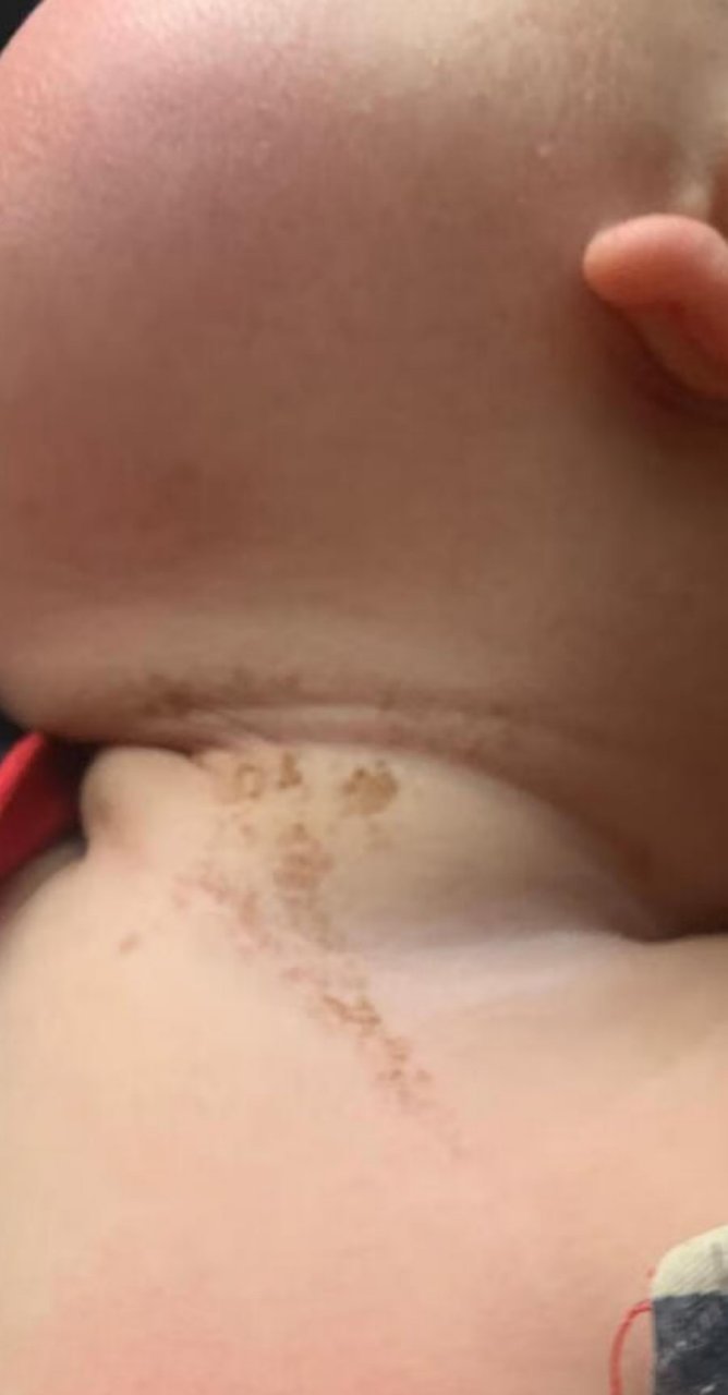 线性疣状表皮痣#激光美容