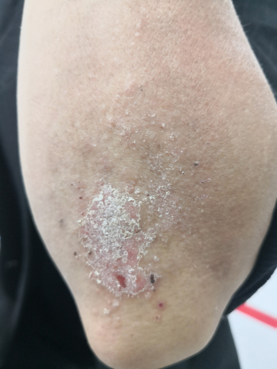 四肢散发的苔藓样变皮疹足跟角化型湿疹症状#解决皮肤问题专注皮肤