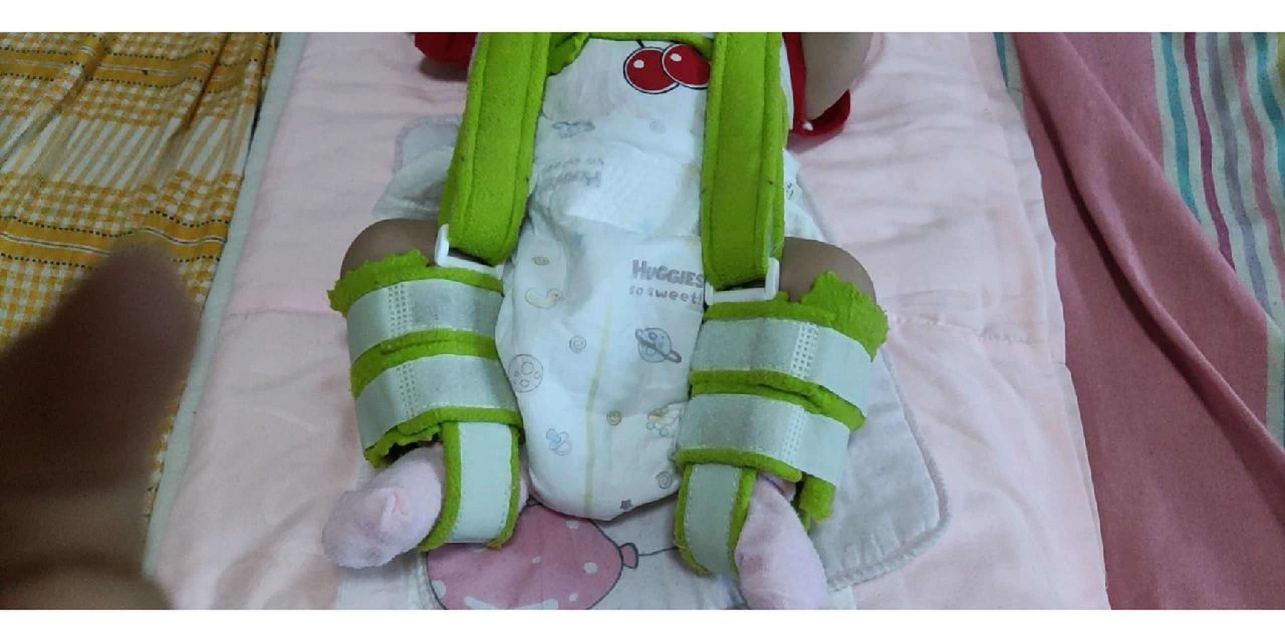 髋关节脱位 #pavlik吊带  ,宝贝刚出生第二天新生儿筛查,结果双侧髋