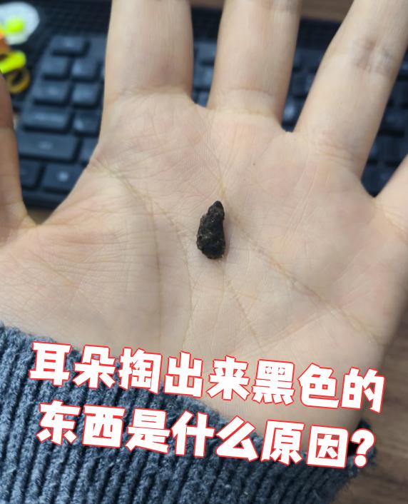 耳朵里掏出来的黑色东西,最常见的是耳屎