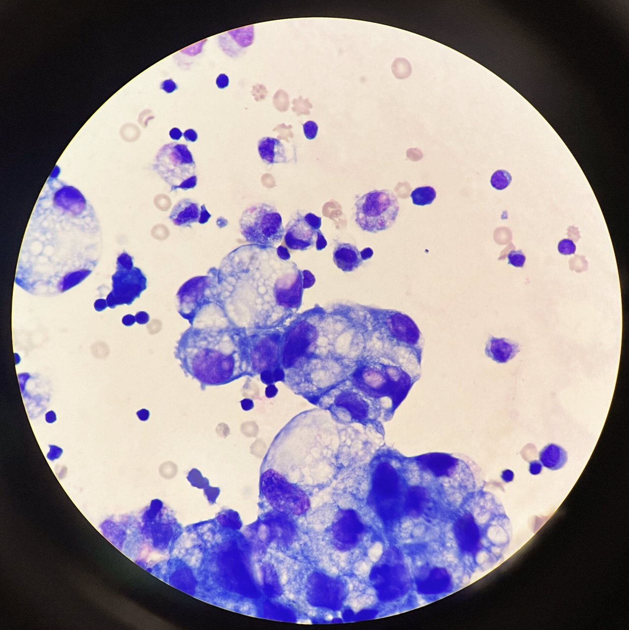 腺癌细胞 腺癌细胞,瑞氏-吉姆萨染色,油镜视野.