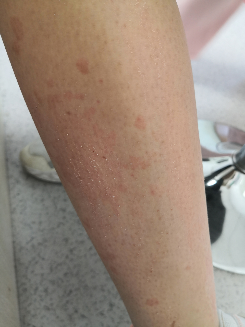 暗红色,考虑头孢类药物过敏导致的荨麻疹型药疹