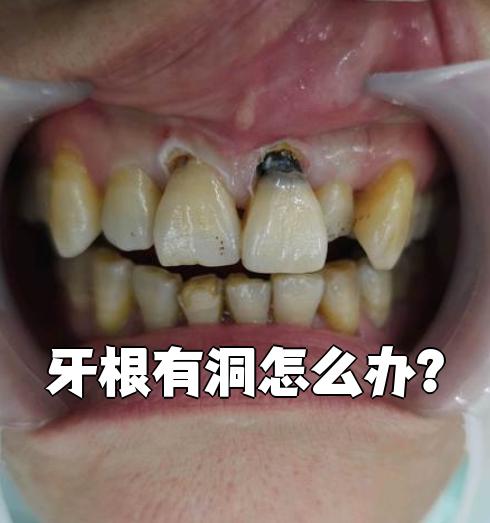 牙根上出现洞,最常见的原因是根面龋