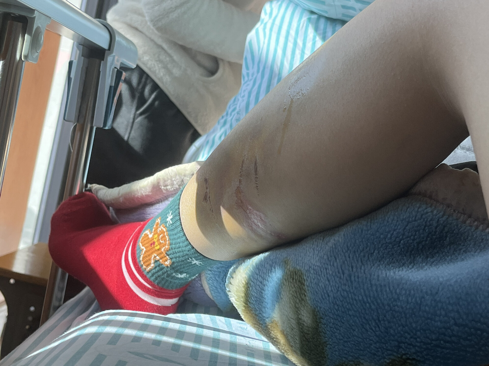 骨盆骨折的第四十八天,骨头微痛,不移动无痛感,骨痂还没长好,可以坐立