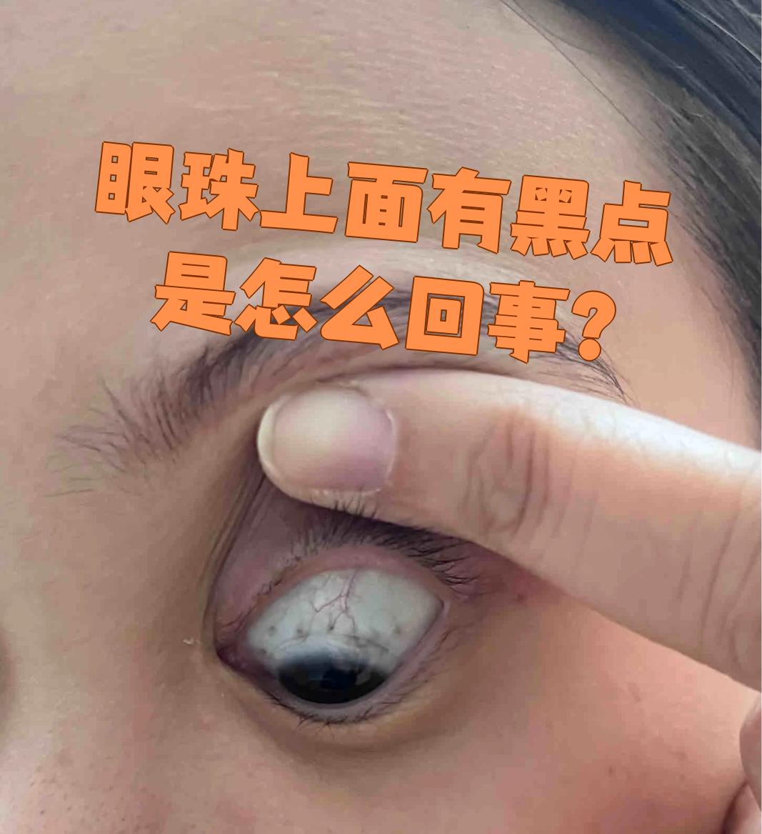 眼珠上出现黑点最常见的原因是色素痣或黑色素瘤