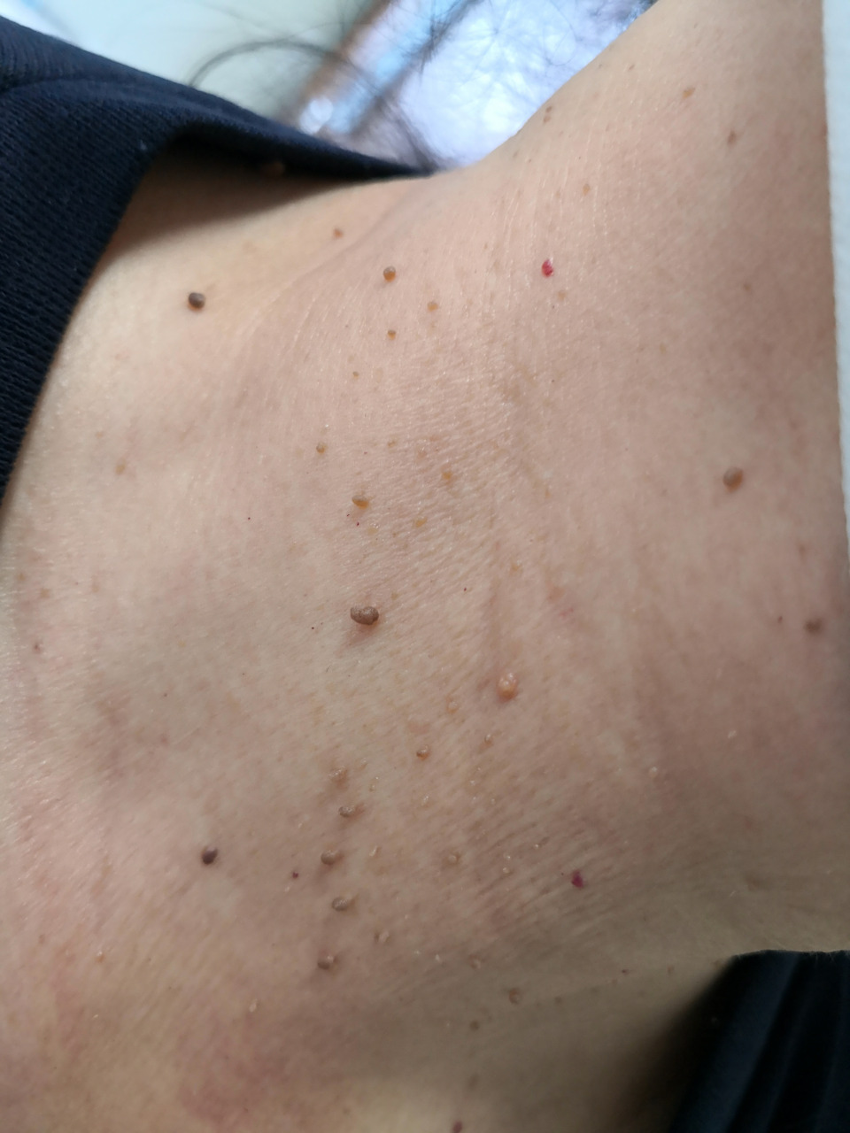 操作简单方便效果可靠#解决皮肤问题专注皮肤美容##皮赘