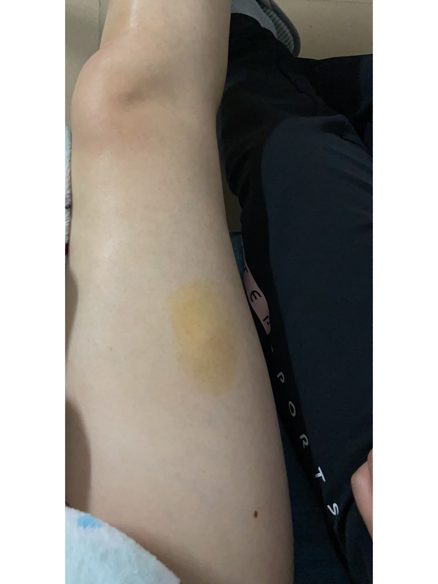 肝素打大腿,这个位置对吗? 打肝素第4个月,肚子成了重灾区.