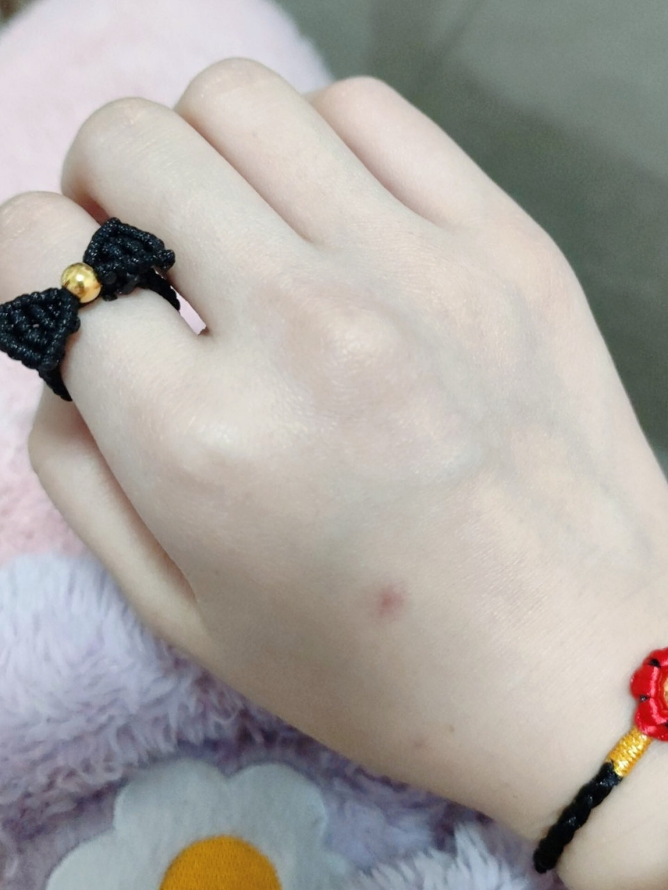 这是什么痣? 有人知道这是什么吗?