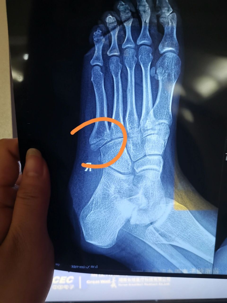 第五趾骨骨折,不疼怎么回事 六月中旬滑滑板摔了一跤,摔的时候特别疼