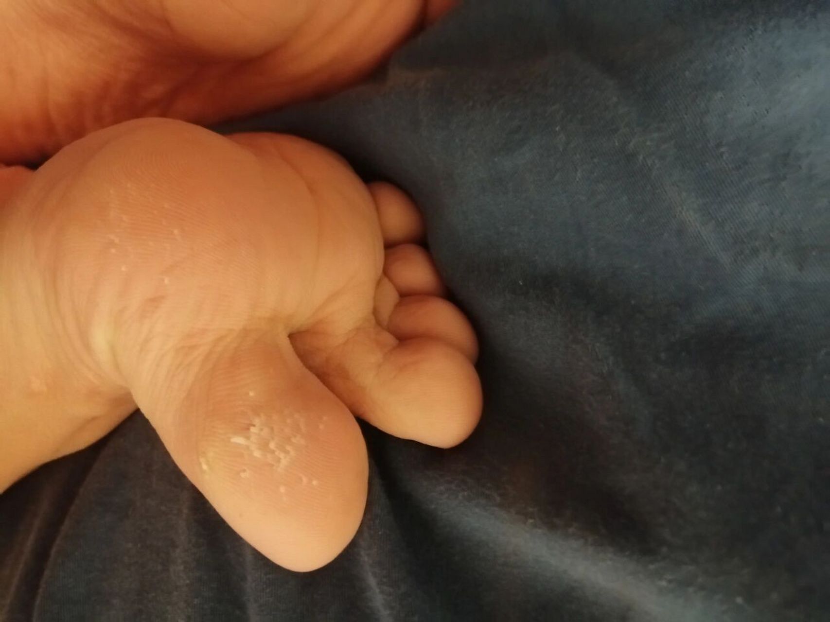 大母脚趾很多倒刺怎么回事? 一直这样,我属于干脚,其他地方没有.