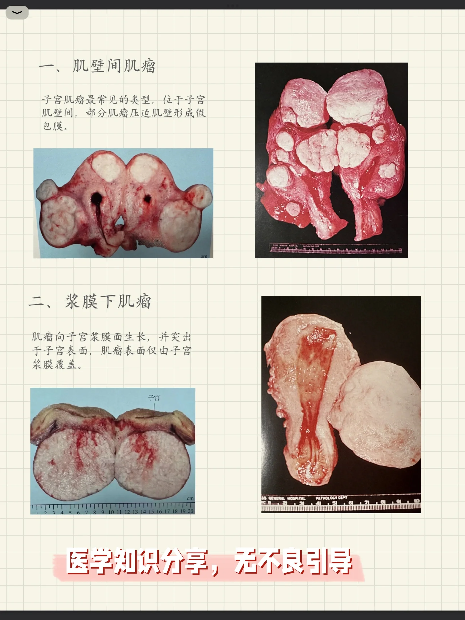 前壁肌壁间子宫肌瘤图图片