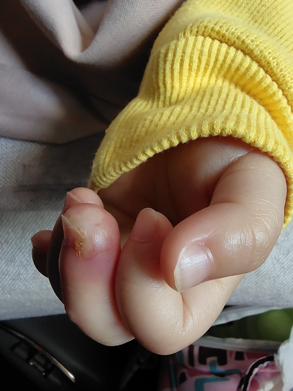 宝宝手,口唇带状疱疹治疗 2020年10月份,宝宝身体不