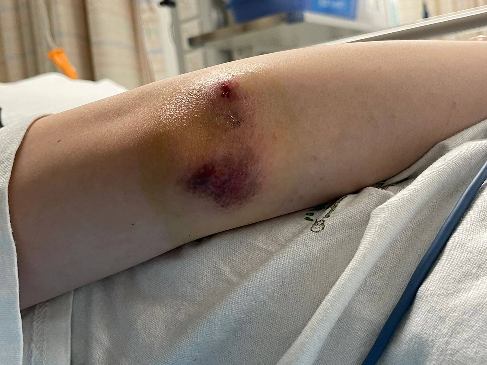 第一天大外医生清创痛的无法呼吸