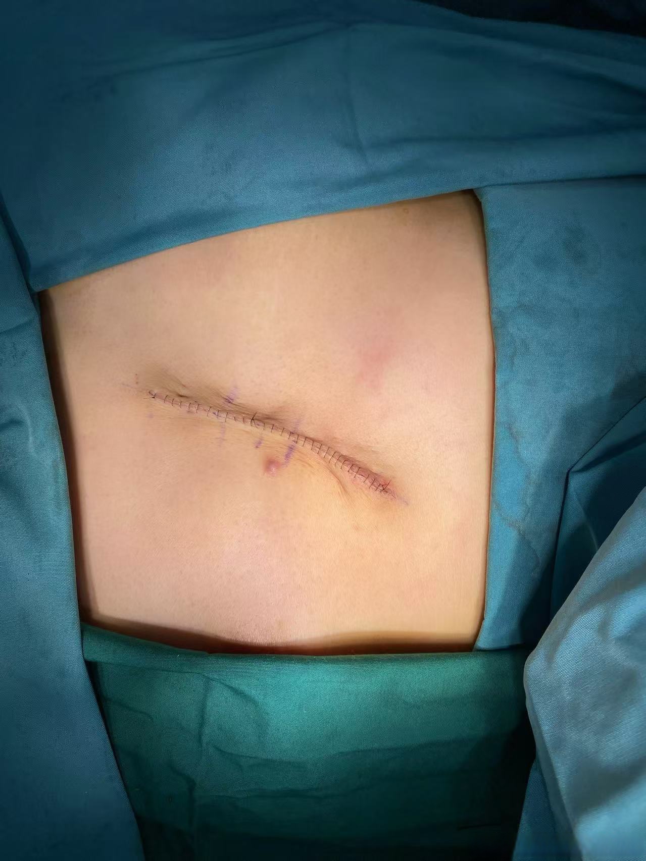 如果疤痕连的比较近,也有可能要分次切除