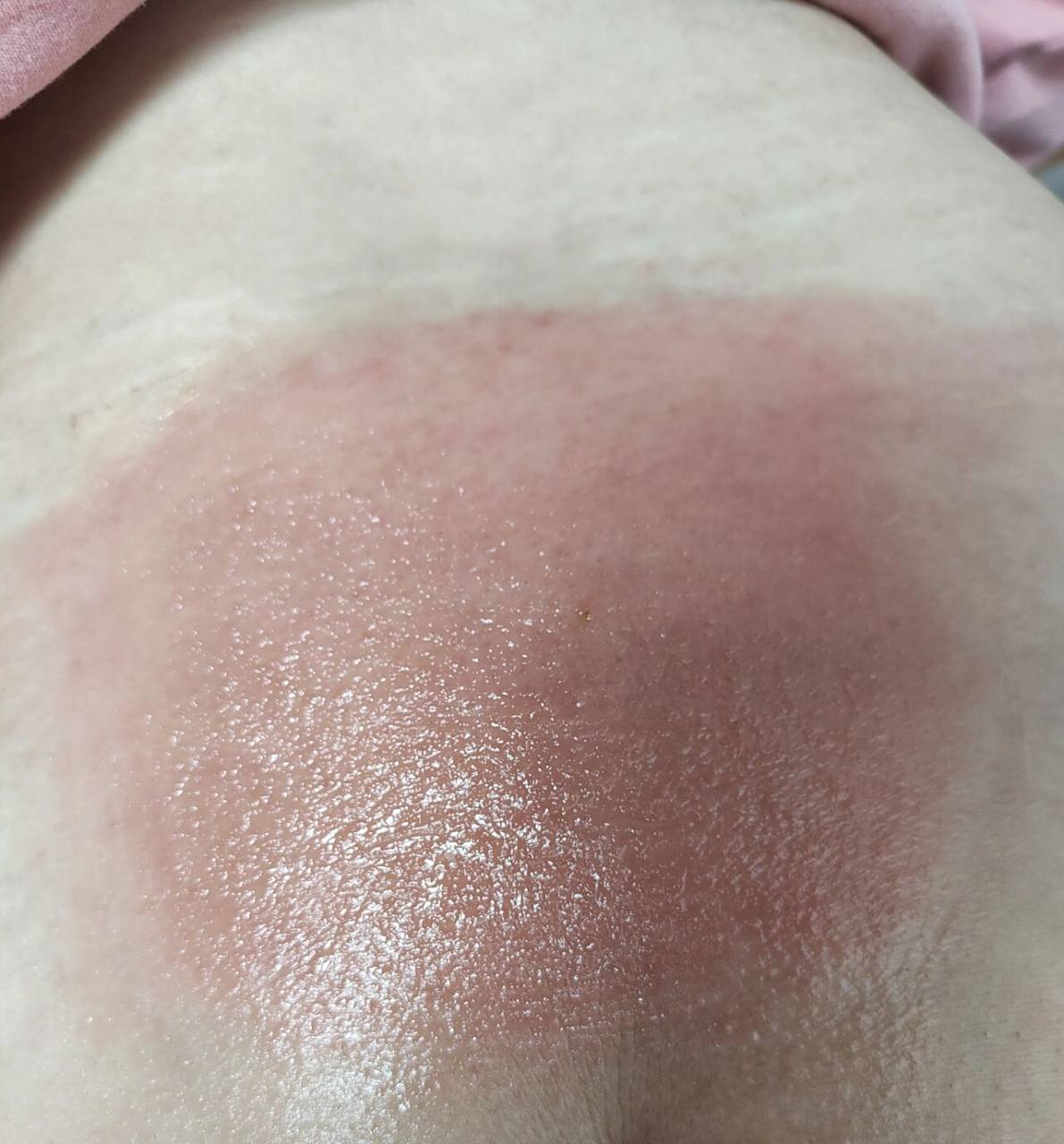 膏药过敏 剖腹产后背漏风,贴膏药时间长,过敏了,红肿瘙痒,有知道涂