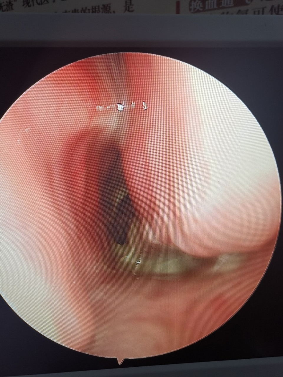 牙源性上颌窦炎