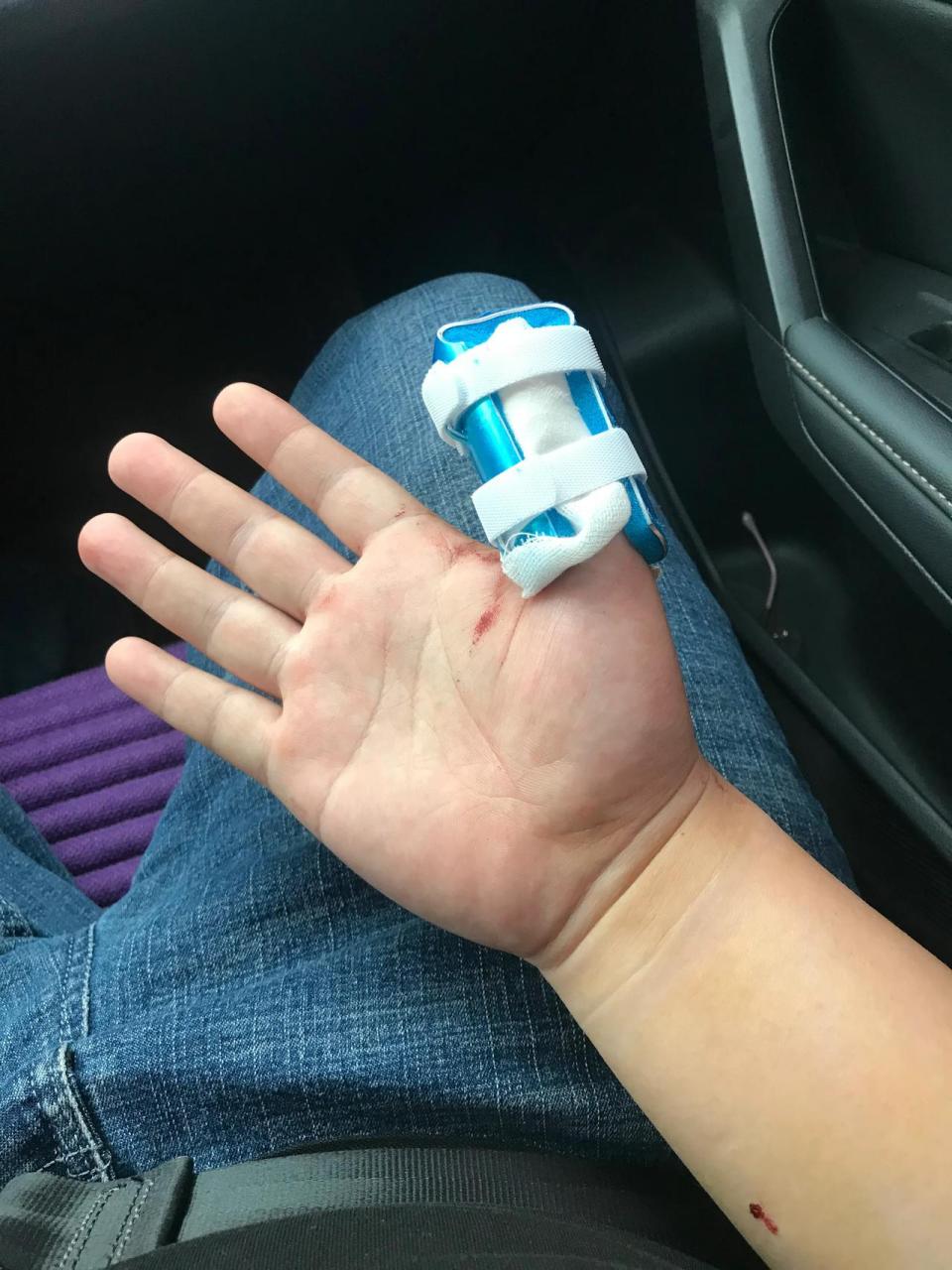 人要走霉运,喝凉水都塞牙,开车出去被自己的车门夹断了手指,虽是骨折