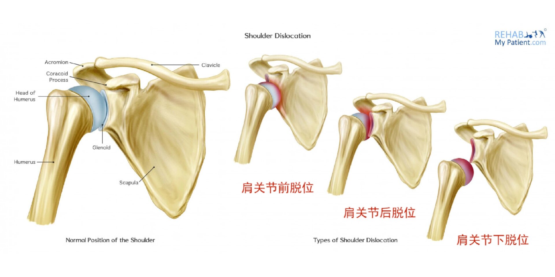 肩关节脱位示意图图片