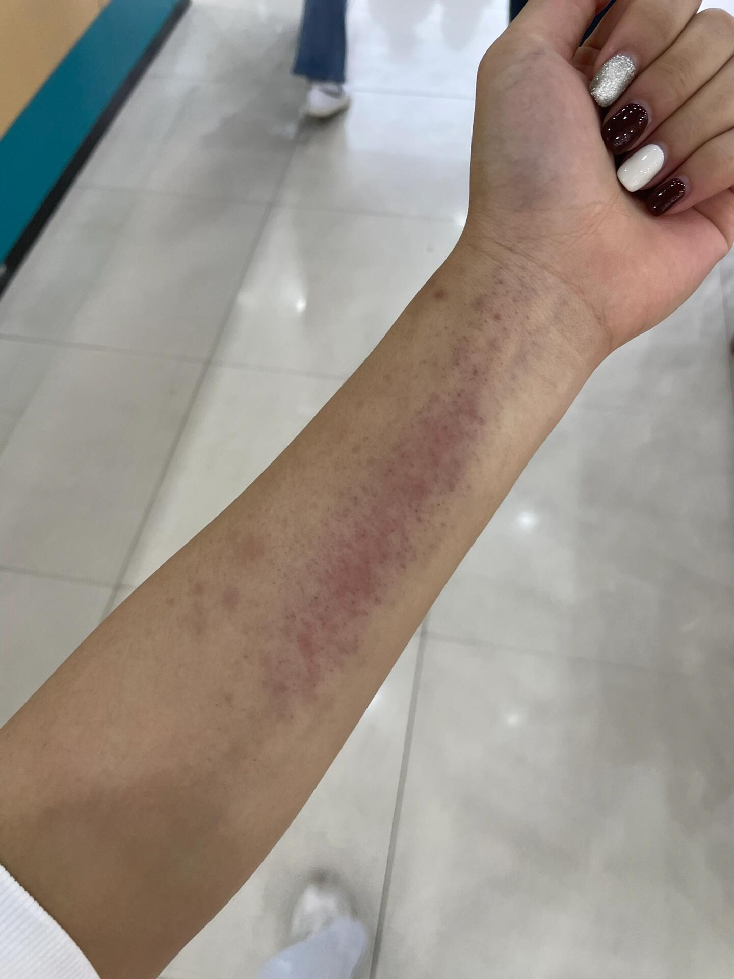 记录第一次练排球的手臂 每天的对比图 本来前几张的红点淤青都要好了