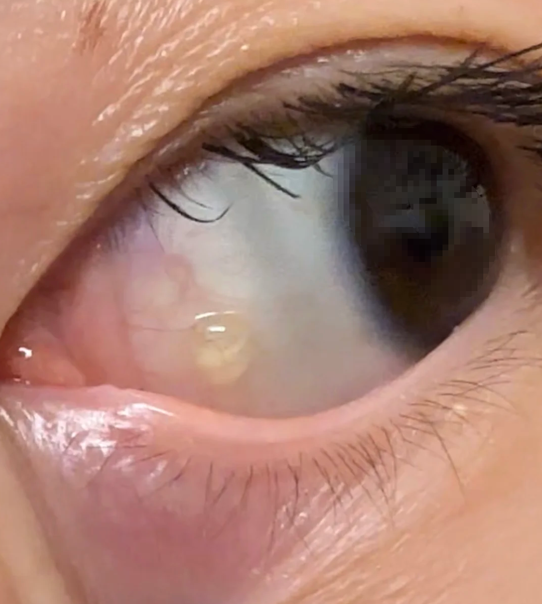 眼球上起了个透明水泡磨眼睛怎么回事怎么办?