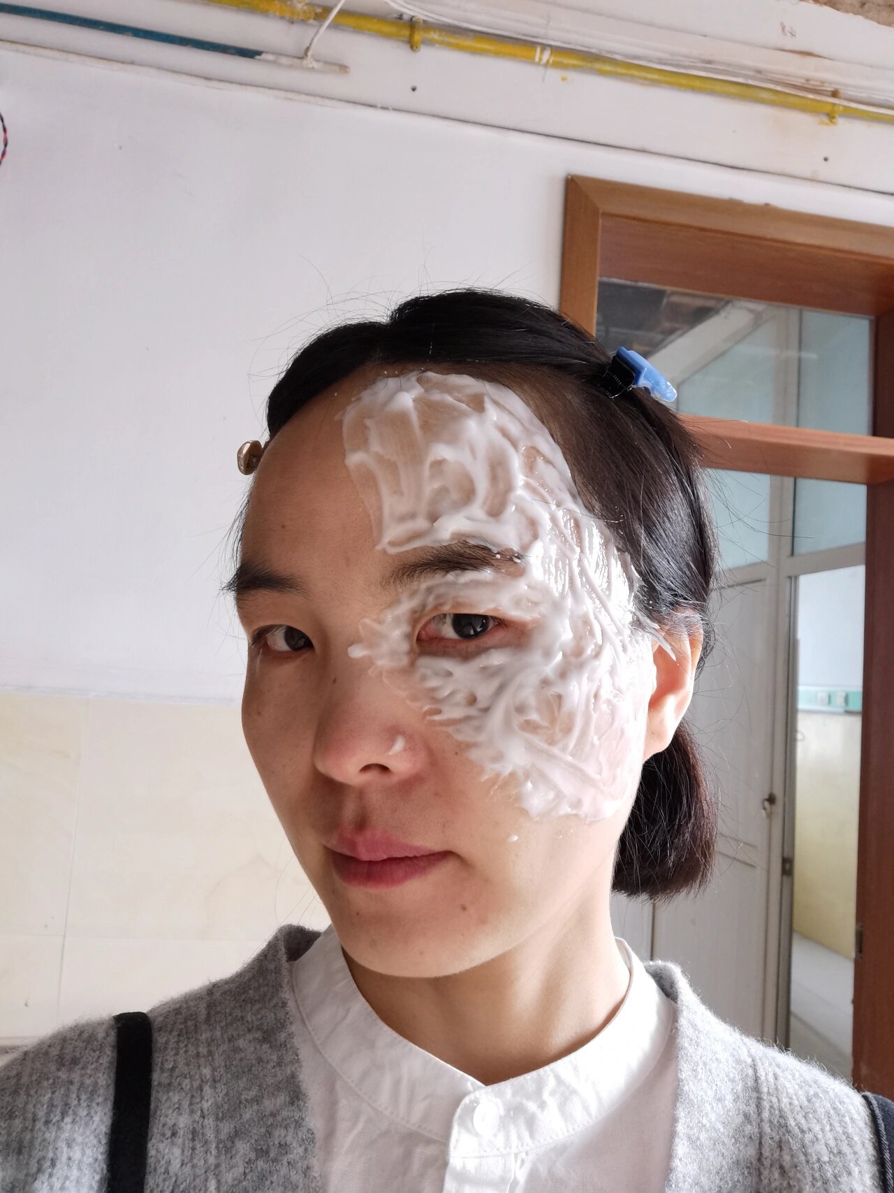 第五次太田痣激光治疗了