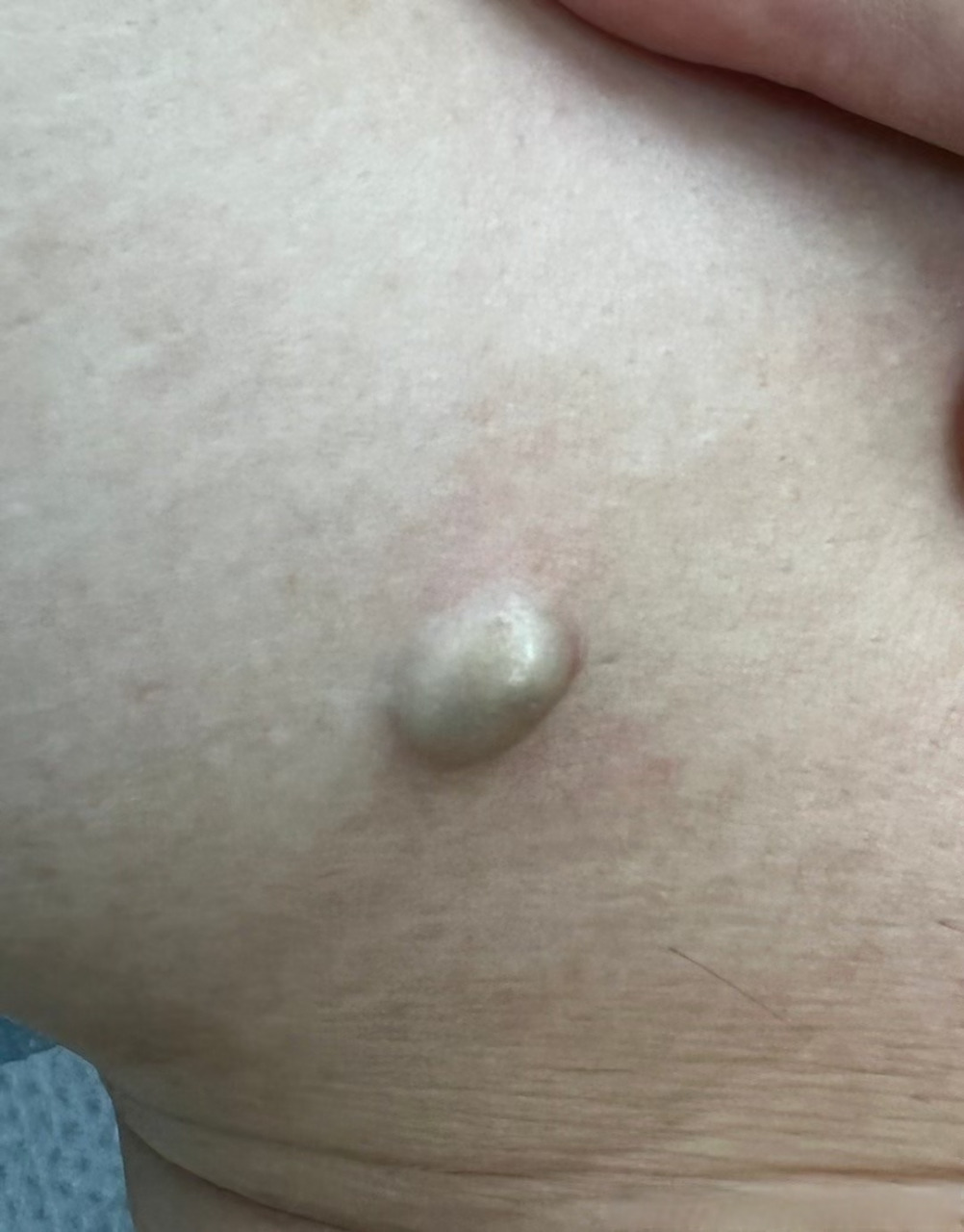 早上给一个小伙子做的皮脂腺囊肿手术 出于完美主义的癖好,我总想把