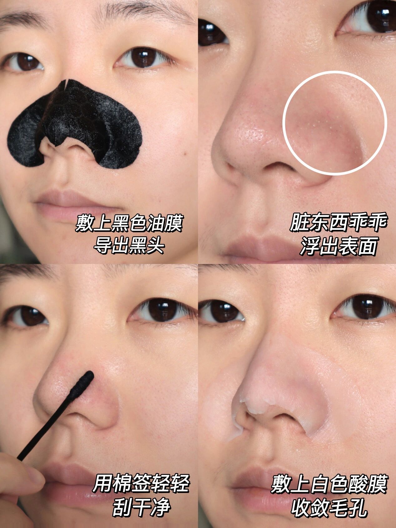 酒糟鼻去黑头太难了 泥膜敷完一揉搓我的鼻子就泛红起皮 反正前前后