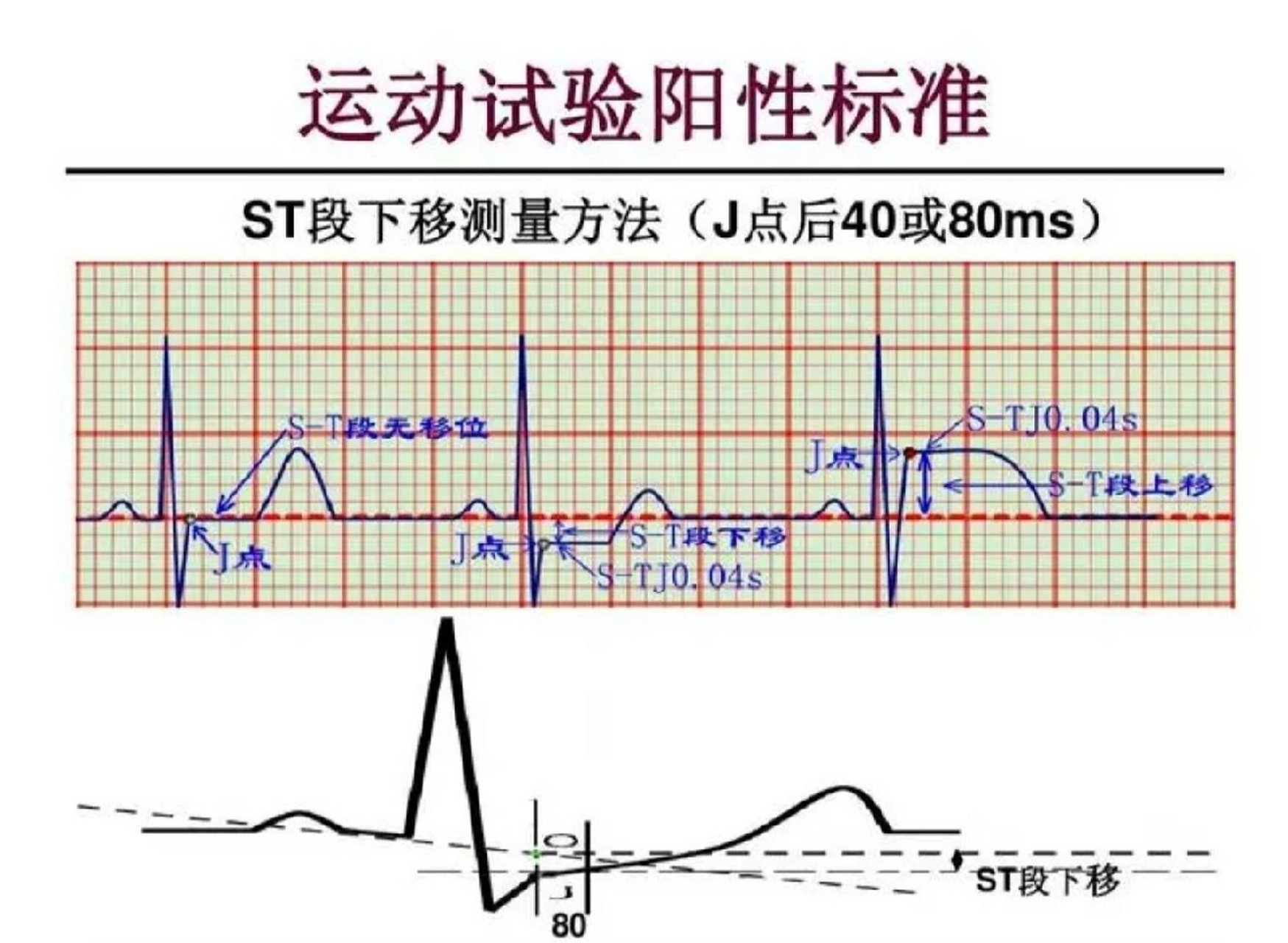 心电图平板运动试验图片