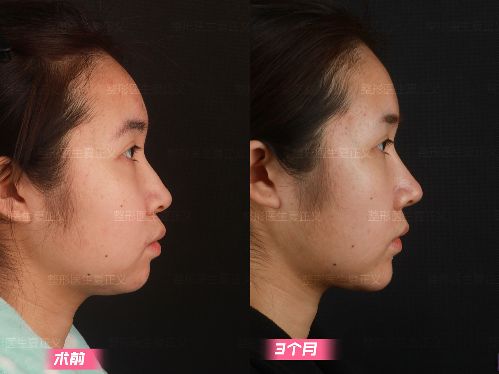 鼻唇角过小,视觉上会显得嘴凸,影响鼻子的挺拔程度; 2.