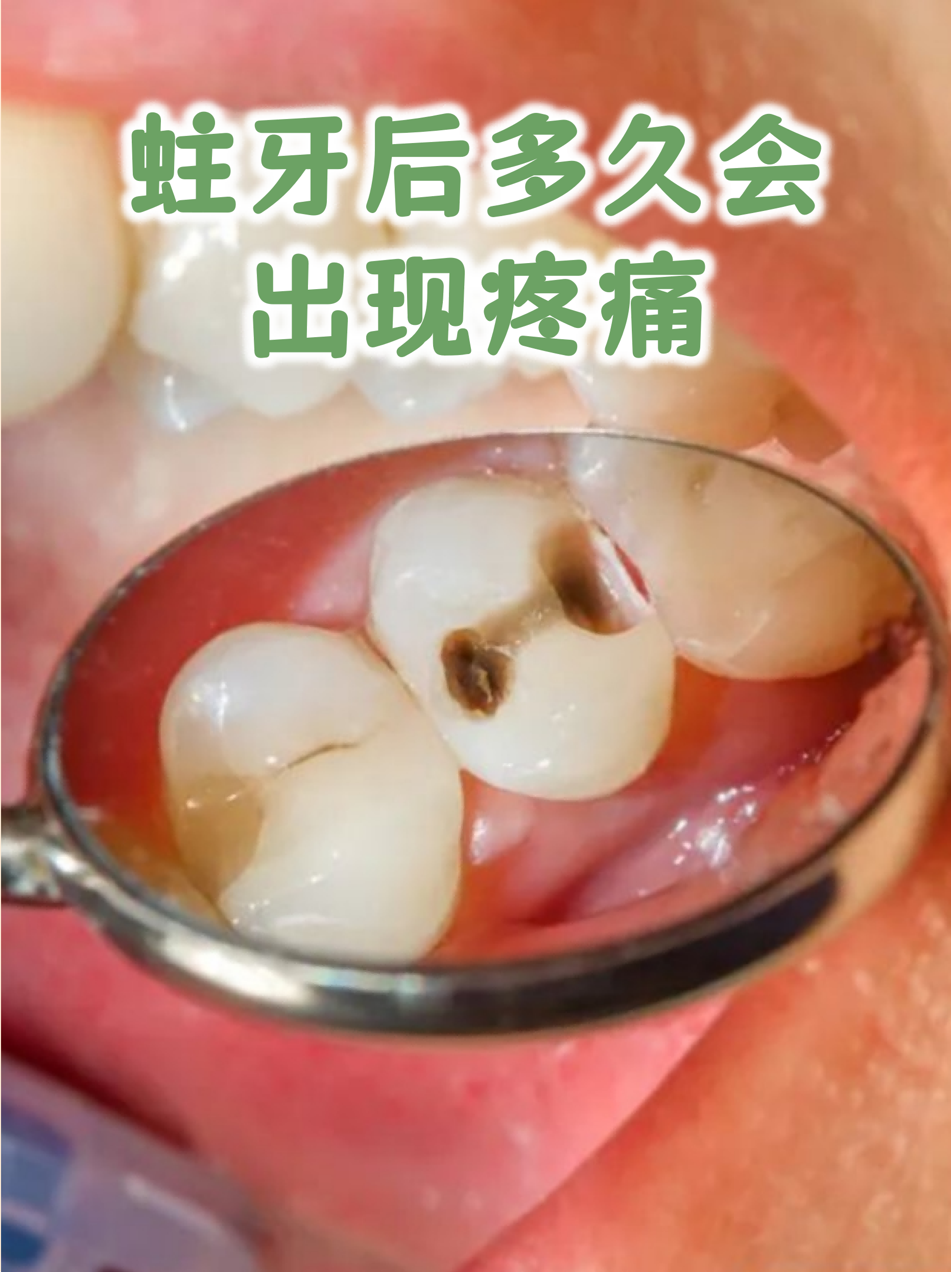  病毒对牙齿的危害有哪些(牙齿病毒病用什么药)