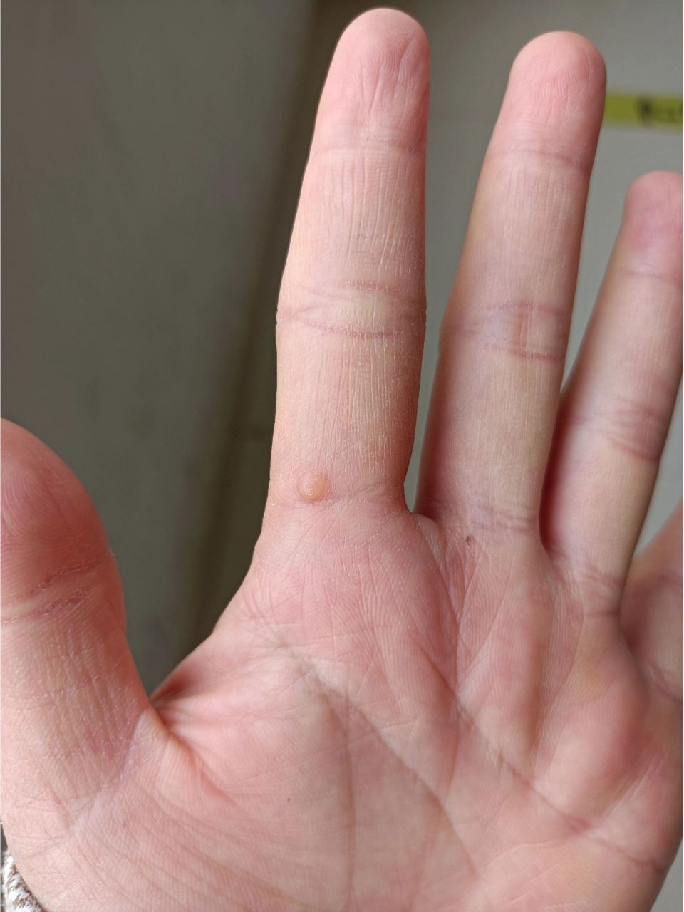 手指疣 #液氮冷冻 手指一个月前长一个凸起的小颗粒,摸着手感粗糙不 