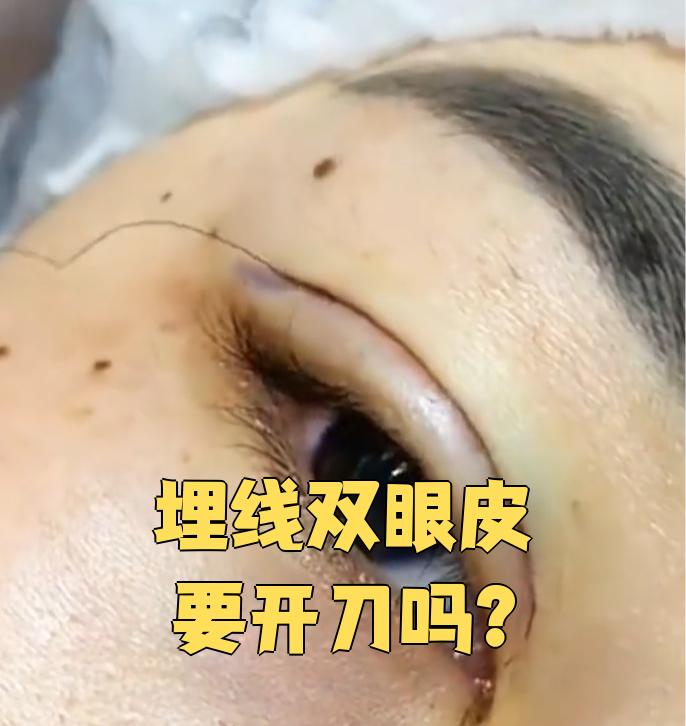 这种手术是通过把可吸收的蛋白线埋在上眼睑皮肤里,形成自然的双眼 