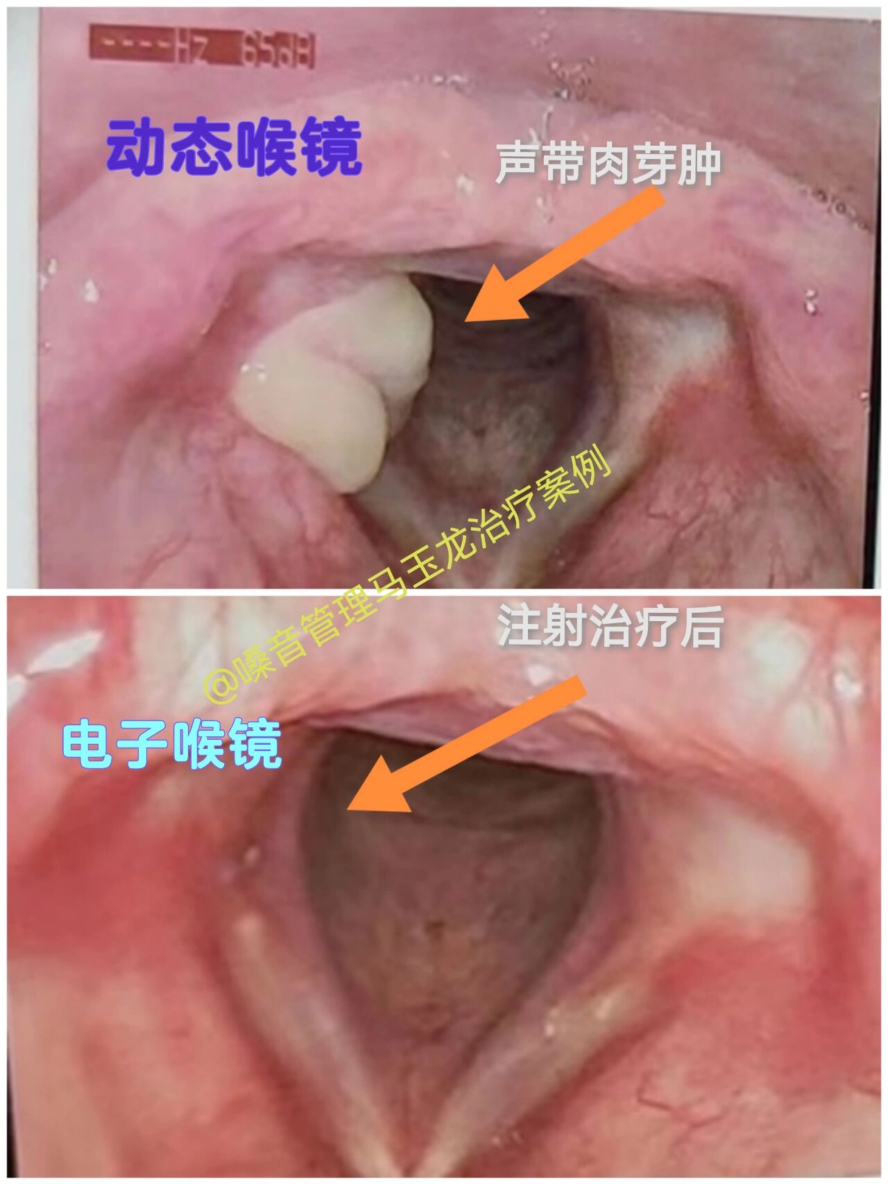 声带肉芽肿注射治疗两次治愈的男生 以往的声带肉芽肿治疗经验,女生