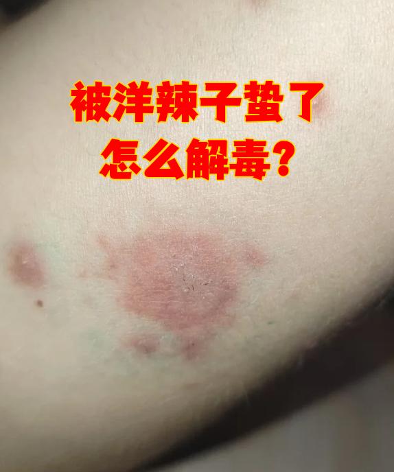 被洋辣子蛰了之后要马上处理