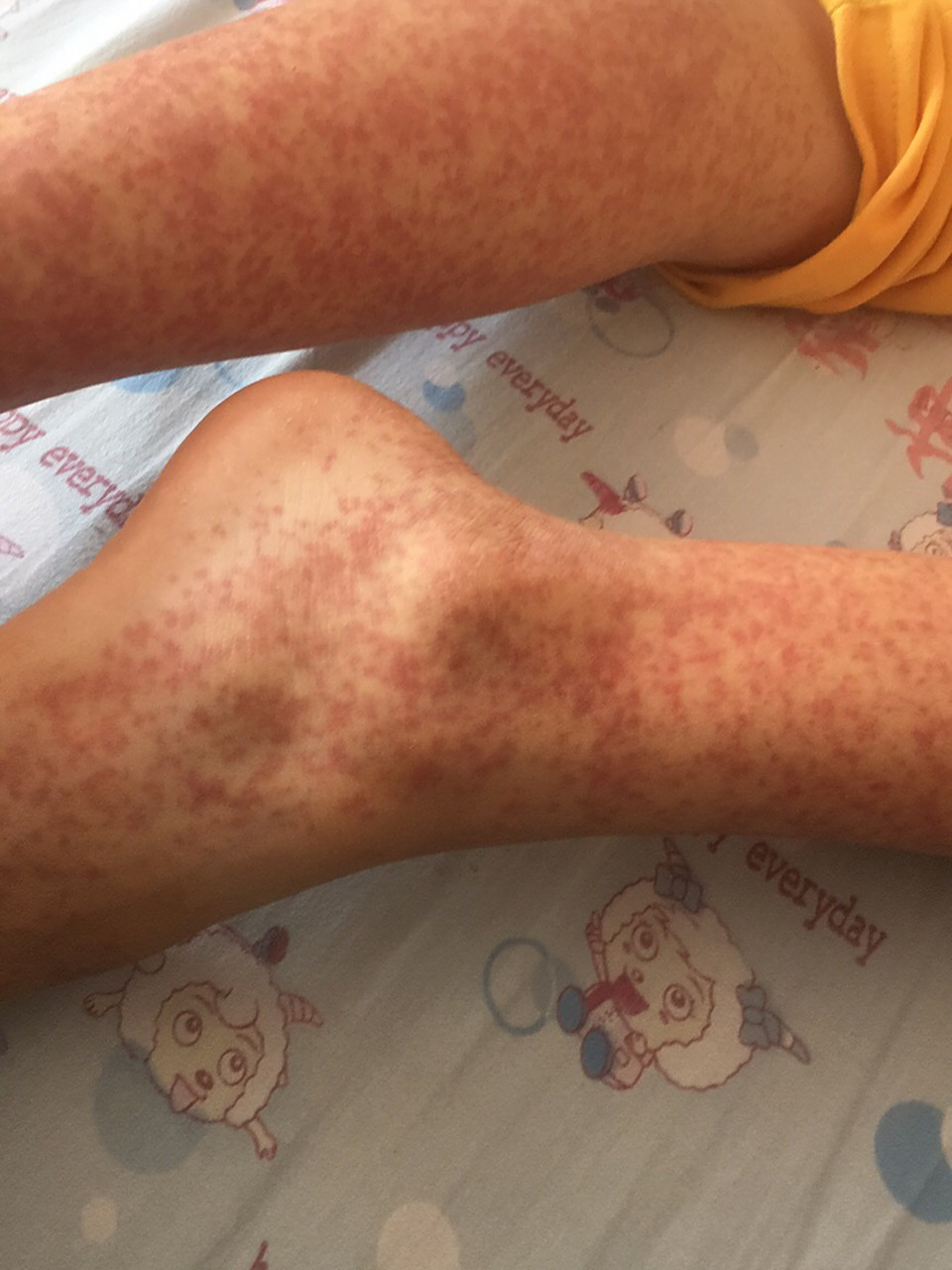 各位朋友们帮忙看看我家孩子十二岁过敏性紫癜这是第三次复发了,知道