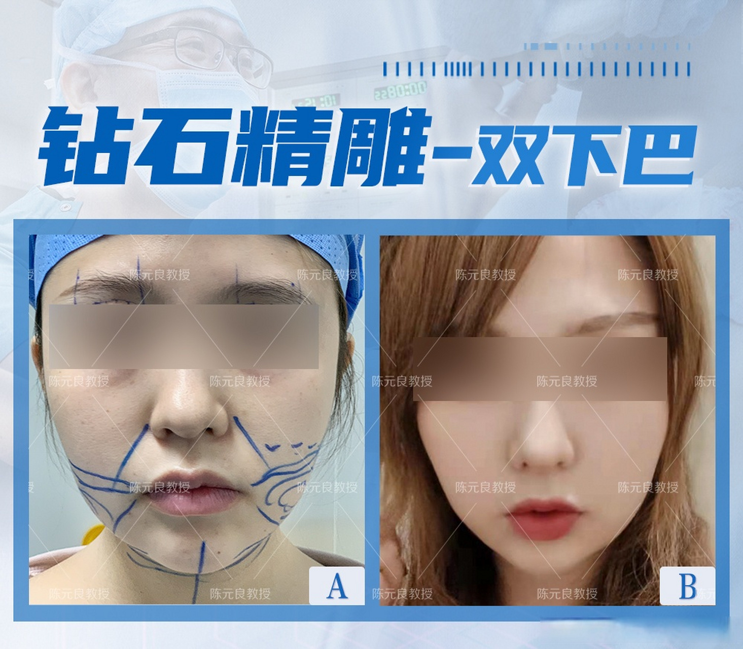 双下巴钻石精雕效果明显#吸脂#名医面对面