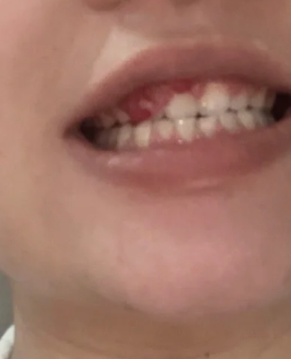 牙缝里长肉芽可能由多种原因引起,比如牙龈乳头炎,牙龈息肉,牙龈瘤