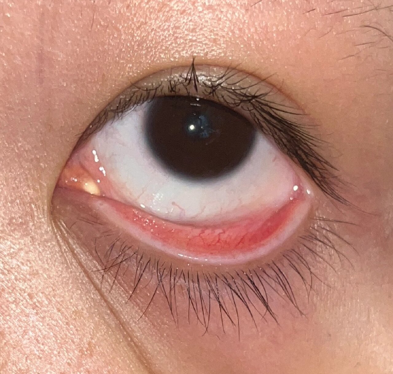 提问眼睛眼睑下面白色长条是什么啊?