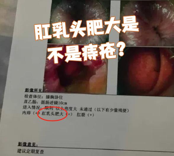 很多人以为肛乳头肥大就是痔疮,其实不是