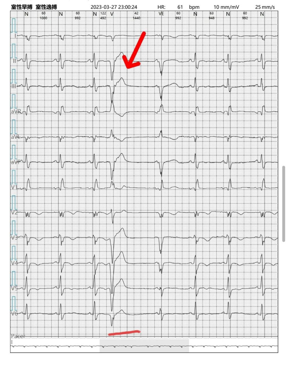 一起学习心电图(室早房早之简单入门) 最近神内接触的都是脑梗患者