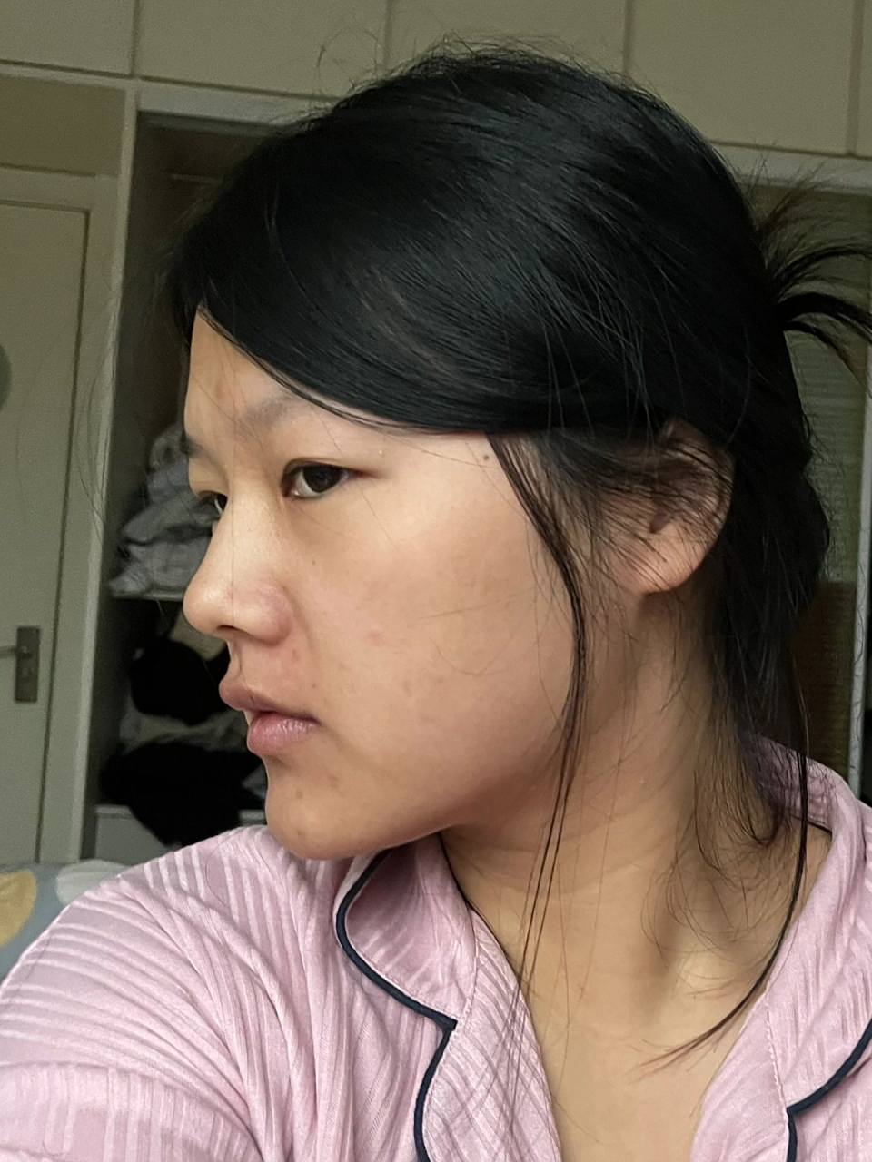 瘪嘴照片更新 正畸瘪嘴,太丑了!