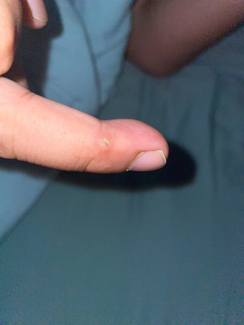 手指上长了一个茧一样的硬包 有人知道这是什么吗?鸡眼还是什么?