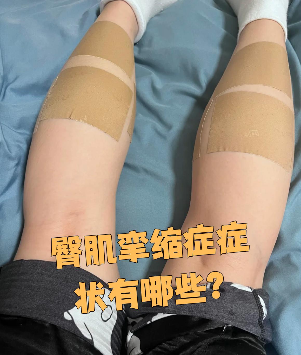 臀肌挛缩症的主要症状包括步态异常,下肢疼痛和骨盆区域疼痛