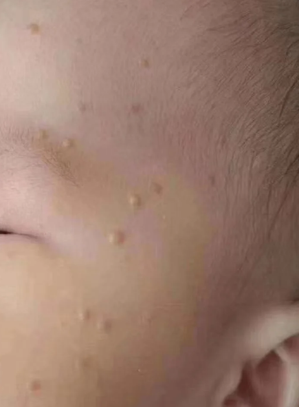 儿童扁平疣的治疗方法主要有三种:冷冻,激光和